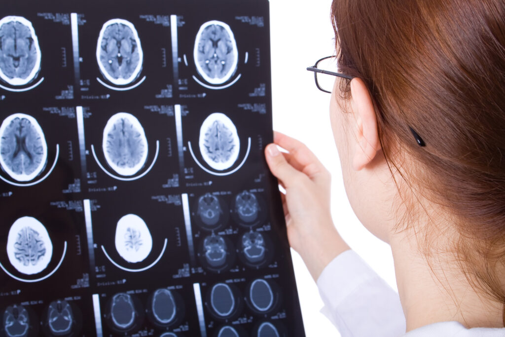 Los Angeles Catastrophic Injury Attorney